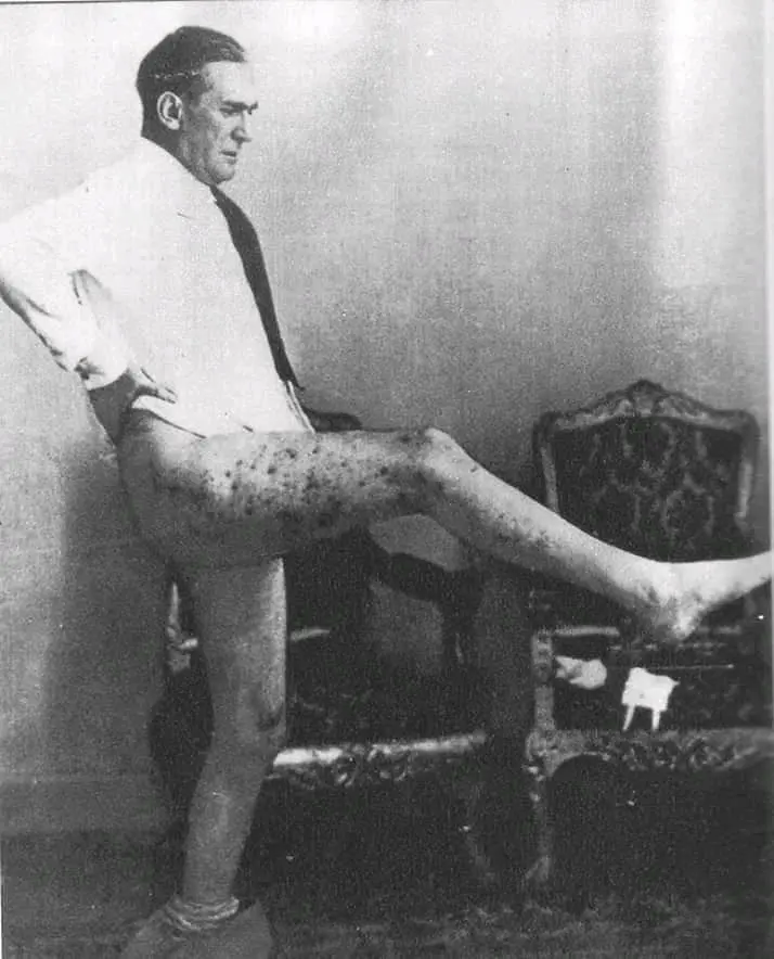 Grazian injured by the bomb dropped by his heroes